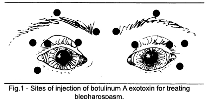 Sites of injection of botulinum A exotoxin for treating blepharospasm
