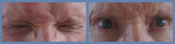 Blepharospasm Treatment And Prognosis 8504